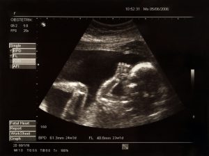 Unborn infant